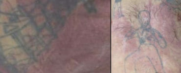 Tetovania na tele neznámeho muža.