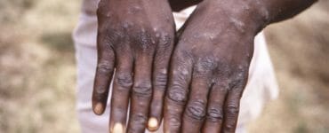 Na snímke z roku 1997 ruky pacienta s opičími kiahňami v Kongu.