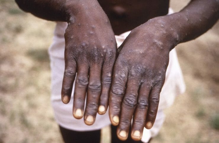 Na snímke z roku 1997 ruky pacienta s opičími kiahňami v Kongu.