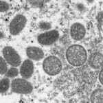 Zrelé vírusové častice opičích kiahní oválneho tvaru (vľavo) a sférické nezrelé vírusové častice získané zo vzorky ľudskej kože (vpravo).